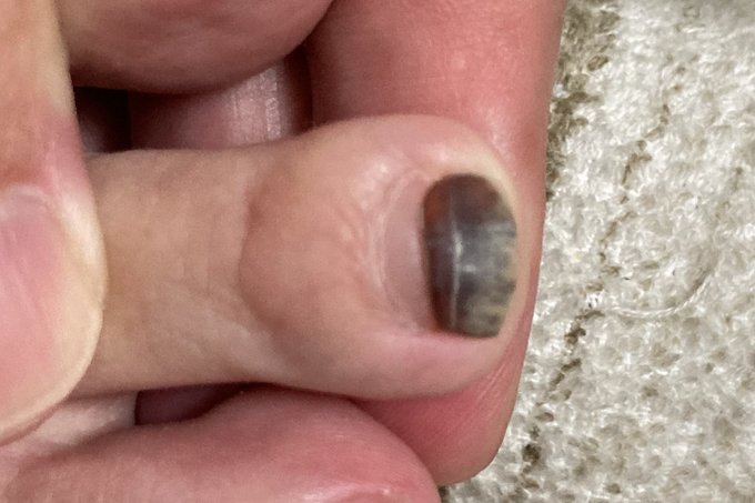 受傷から4ヶ月後の足の爪。根元に新しい爪が2ミリ伸び、黒い内出血が先へ押し出されている